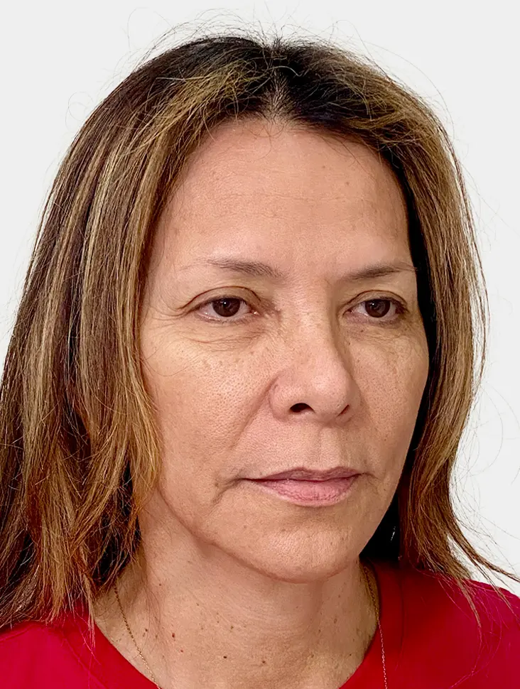 Resultado 2 - Antes